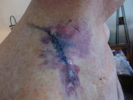Post-Op
